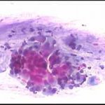 Ομάδα αδενικών κυτταρων ενδοτραχήλου. Χρώση με Cytocolor, μεγέθυνση 10Χ10